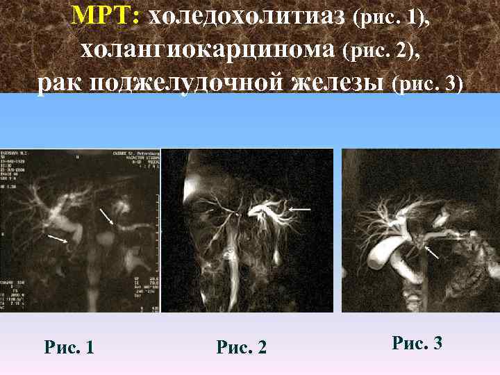 МРТ: холедохолитиаз (рис. 1), холангиокарцинома (рис. 2), рак поджелудочной железы (рис. 3) Рис. 1
