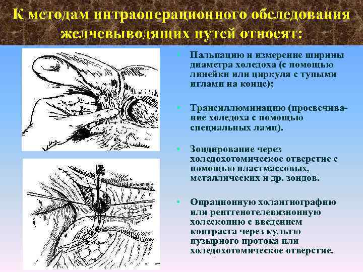 К методам интраоперационного обследования желчевыводящих путей относят: • Пальпацию и измерение ширины диаметра холедоха