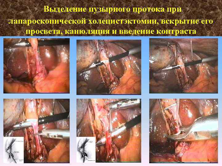 Выделение пузырного протока при лапароскопической холецистэктомии, вскрытие его просвета, канюляция и введение контраста 