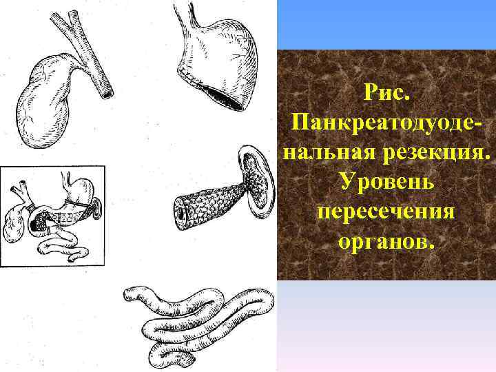 Рис. Панкреатодуоде нальная резекция. Уровень пересечения органов. 