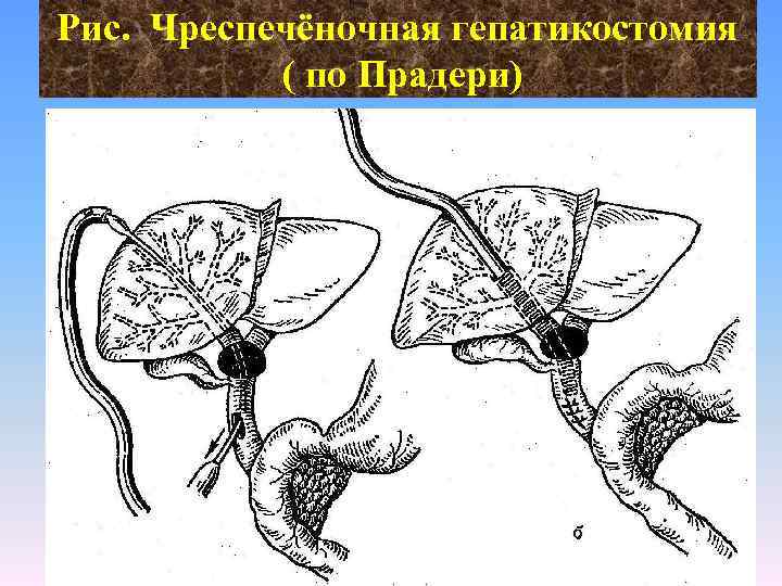 Рис. Чреспечёночная гепатикостомия ( по Прадери) 