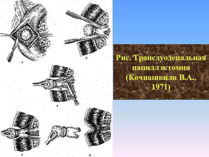 Рис. Трансдуоденальная папиллэктомия (Кочиашвили В. А. , 1971) 