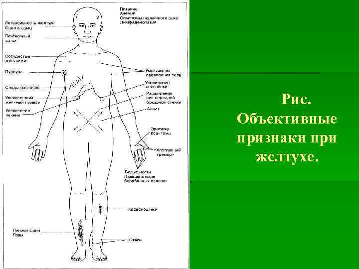 Рис. Объективные признаки при желтухе. 