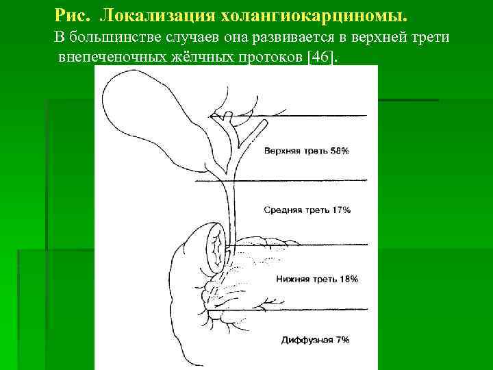 Рис. Локализация холангиокарциномы. В большинстве случаев она развивается в верхней трети внепеченочных жёлчных протоков