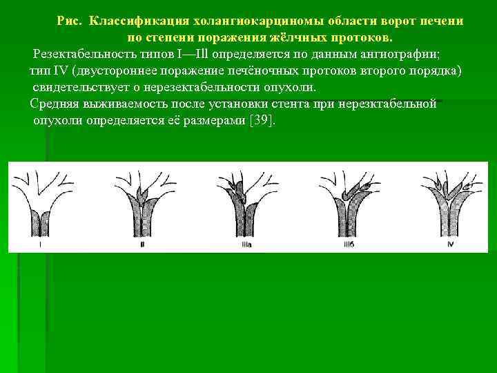 Рис. Классификация холангиокарциномы области ворот печени по степени поражения жёлчных протоков. Резектабельность типов I—Ill