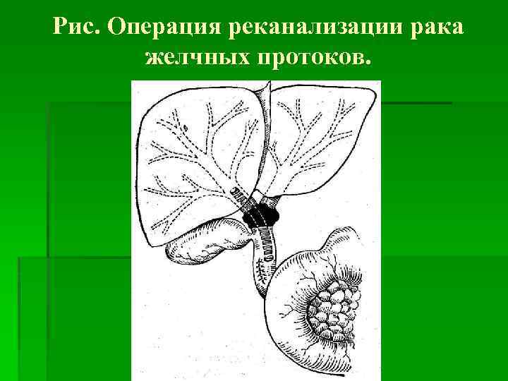 Рис. Операция реканализации рака желчных протоков. 