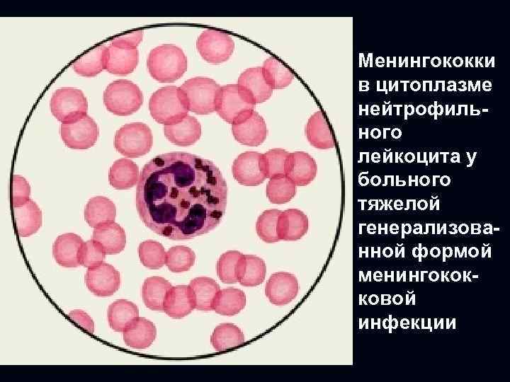 Менингококки в цитоплазме нейтрофильного лейкоцита у больного тяжелой генерализованной формой менингококковой инфекции 