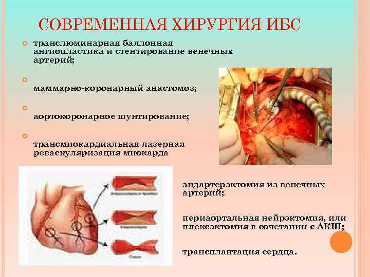 СОВРЕМЕННАЯ ХИРУРГИЯ ИБС транслюминарная баллонная ангиопластика и стентирование венечных артерий; маммарно-коронарный анастомоз; аортокоронарное шунтирование;