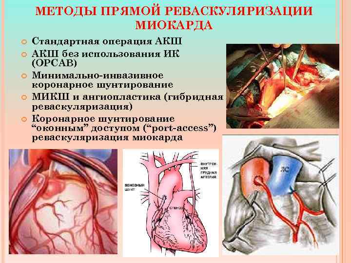 МЕТОДЫ ПРЯМОЙ РЕВАСКУЛЯРИЗАЦИИ МИОКАРДА Стандартная операция АКШ без использования ИК (OPCAB) Минимально-инвазивное коронарное шунтирование