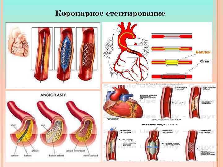 Коронарное стентирование