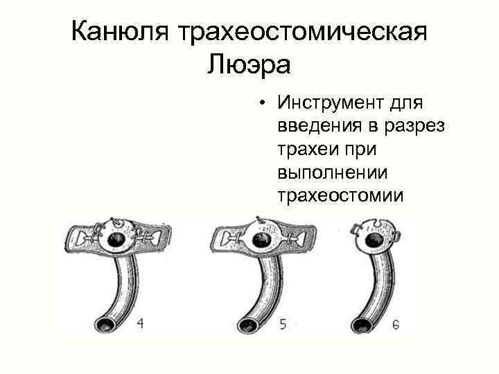 Канюля трахеостомическая Люэра • Инструмент для введения в разрез трахеи при выполнении трахеостомии 