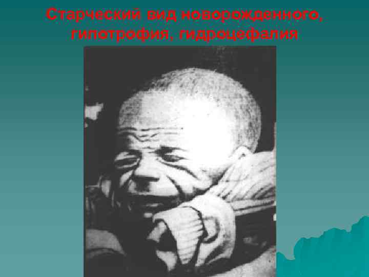 Старческий вид новорожденного, гипотрофия, гидроцефалия 
