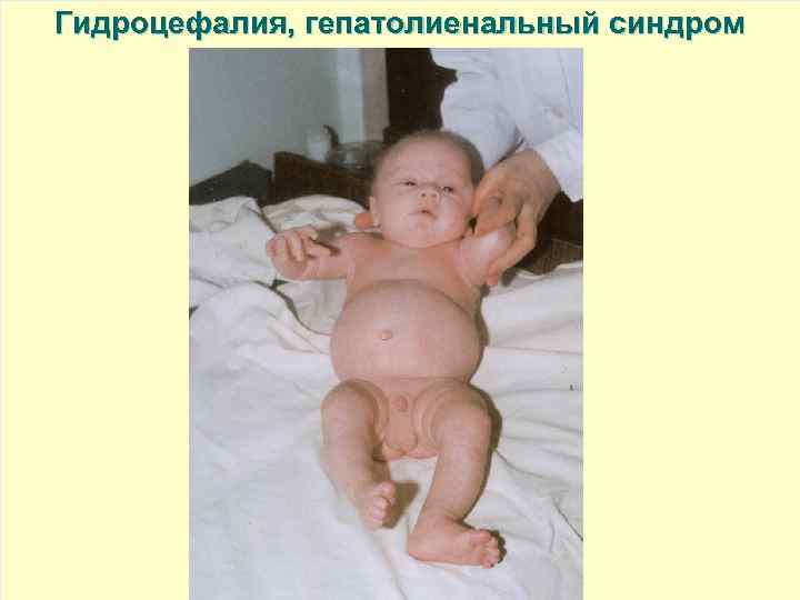 Гидроцефалия, гепатолиенальный синдром 