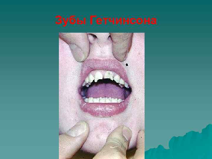 Зубы Гетчинсона 