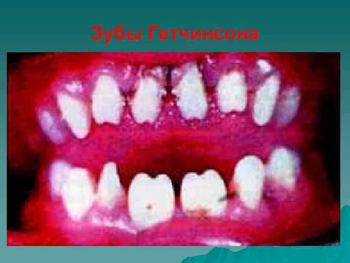 Зубы Гетчинсона 