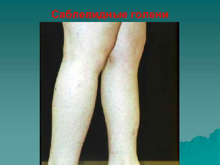 Саблевидные голени 