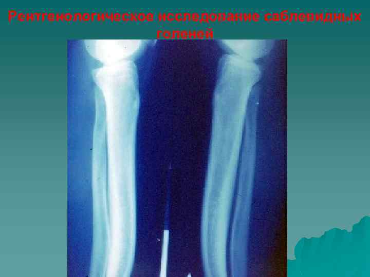 Рентгенологическое исследование саблевидных голеней 