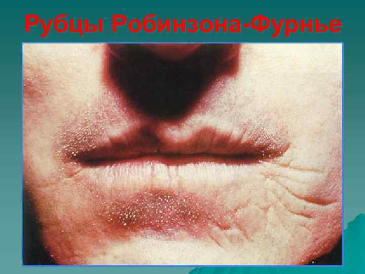 Рубцы Робинзона-Фурнье 