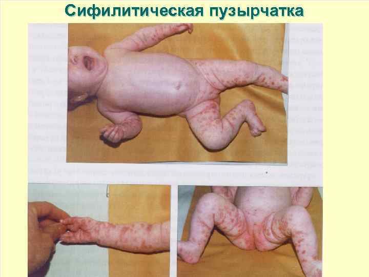 Сифилитическая пузырчатка 