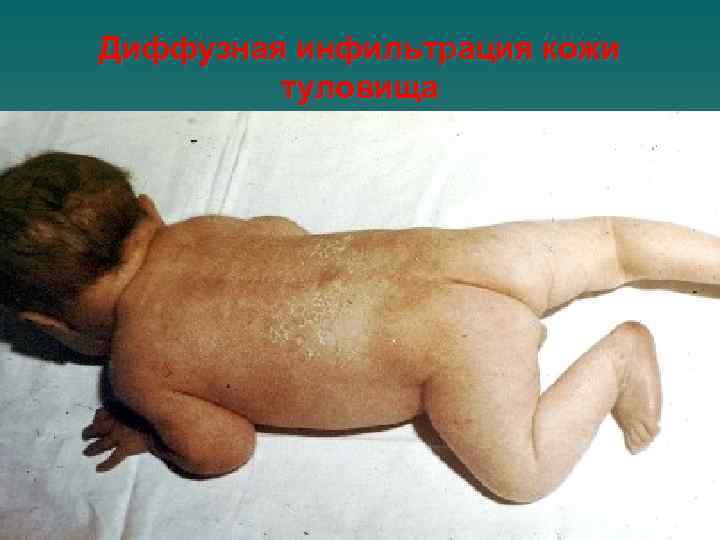 Диффузная инфильтрация кожи туловища 