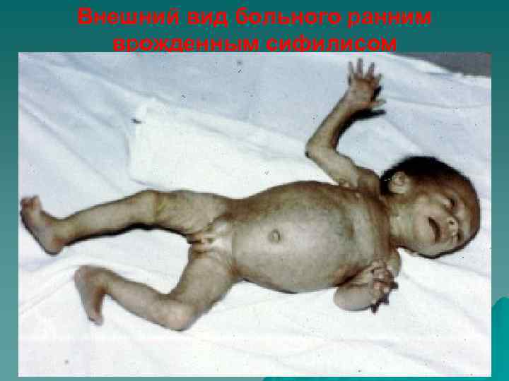 Внешний вид больного ранним врожденным сифилисом 