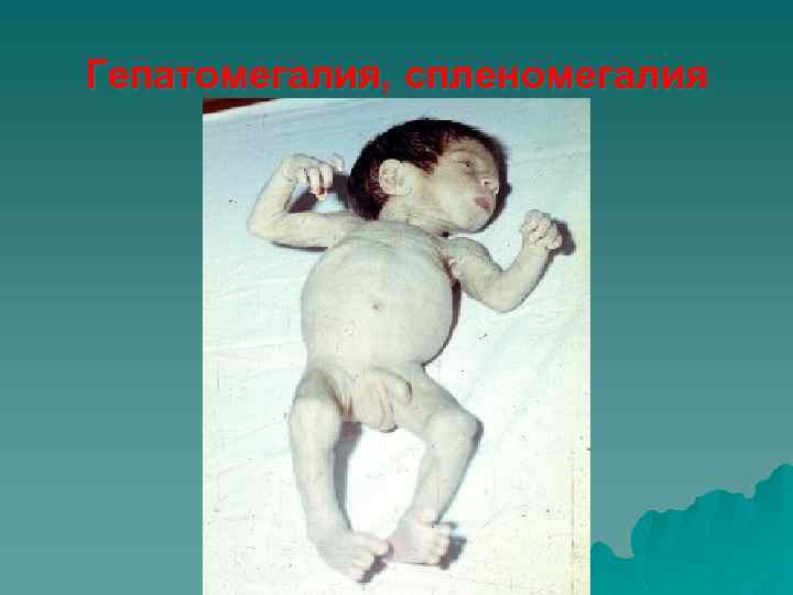Гепатомегалия, спленомегалия 