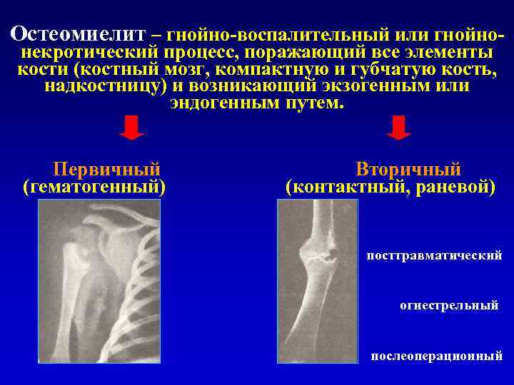 Остеомиелит – гнойно-воспалительный или гнойно- некротический процесс, поражающий все элементы кости (костный мозг, компактную