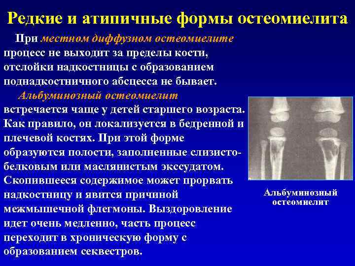 Редкие и атипичные формы остеомиелита При местном диффузном остеомиелите процесс не выходит за пределы