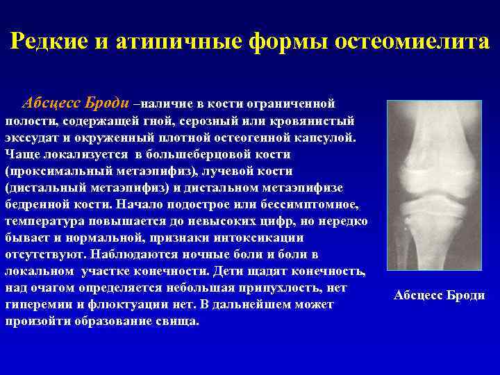 Редкие и атипичные формы остеомиелита Абсцесс Броди –наличие в кости ограниченной полости, содержащей гной,