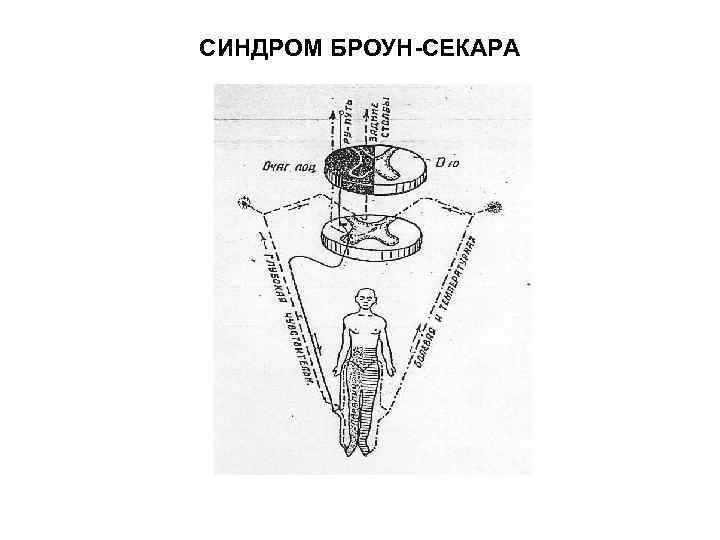 СИНДРОМ БРОУН-СЕКАРА 
