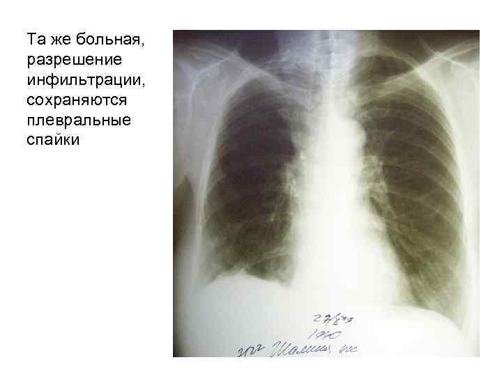 Та же больная, разрешение инфильтрации, сохраняются плевральные спайки 