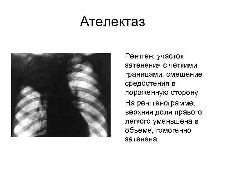 Ателектазы рентген схема