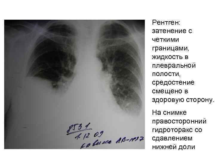 Почему на рентгеновском снимке изображение газа в плевральной полости черное