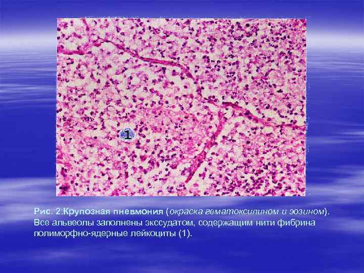 Рис. 2. Крупозная пневмония (окраска гематоксилином и эозином). Все альвеолы заполнены экссудатом, содержащим нити