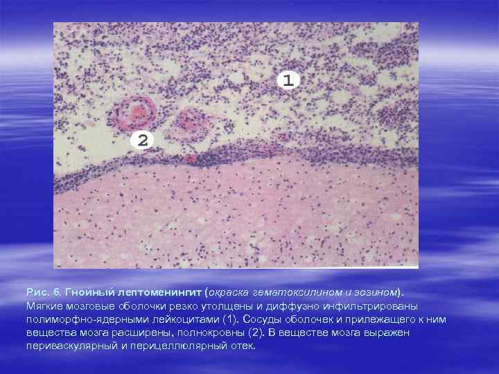 Рис. 6. Гнойный лептоменингит (окраска гематоксилином и эозином). Мягкие мозговые оболочки резко утолщены и