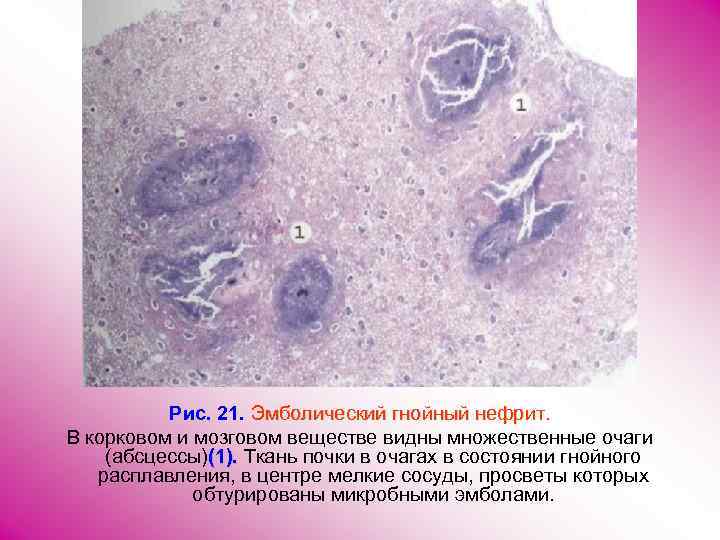 Эмболический гнойный нефрит микропрепарат рисунок