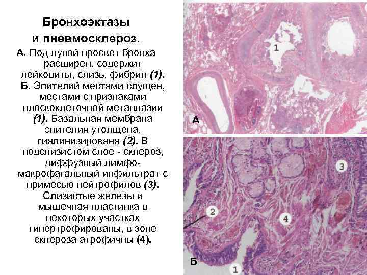 Бронхоэктазы и пневмосклероз. А. Под лупой просвет бронха расширен, содержит лейкоциты, слизь, фибрин (1).