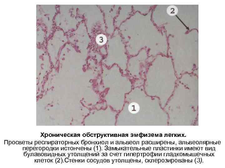 Хроническая обструктивная эмфизема легких. Просветы респираторных бронхиол и альвеол расширены, альвеолярные перегородки истончены (1).