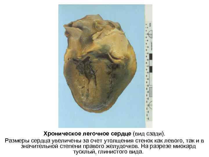 Хроническое легочное сердце (вид сзади). Размеры сердца увеличены за счет утолщения стенок как левого,