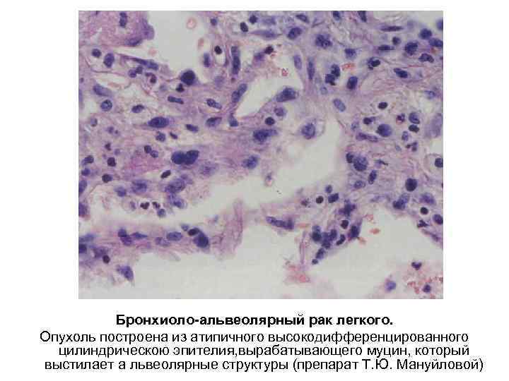 Бронхиоло-альвеолярный рак легкого. Опухоль построена из атипичного высокодифференцированного цилиндрическою эпителия, вырабатывающего муцин, который выстилает