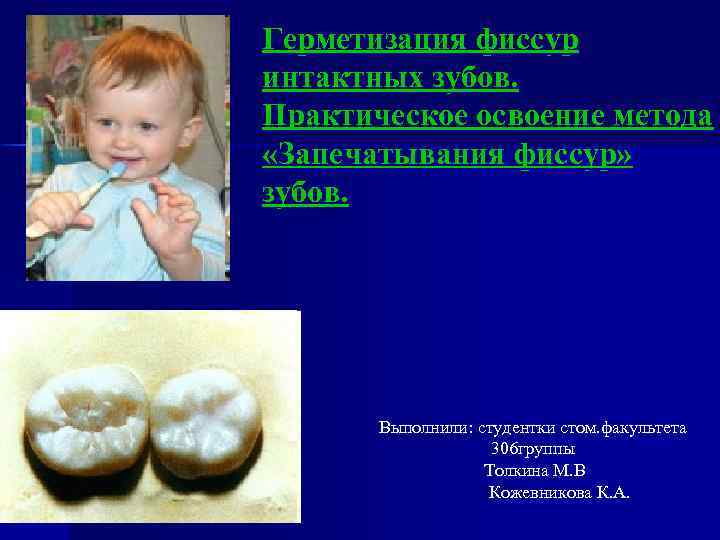 Герметизация фиссур интактных зубов. Практическое освоение метода «Запечатывания фиссур» зубов. Выполнили: студентки стом. факультета
