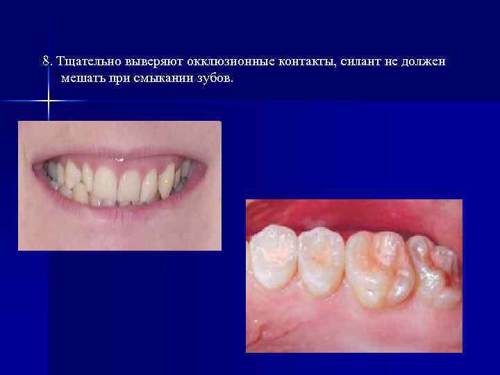 8. Тщательно выверяют окклюзионные контакты, силант не должен мешать при смыкании зубов. 