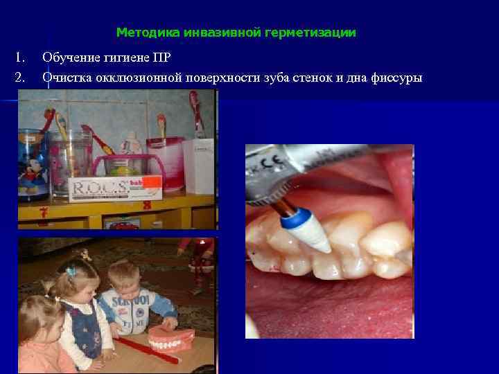 Методика инвазивной герметизации 1. 2. Обучение гигиене ПР Очистка окклюзионной поверхности зуба стенок и