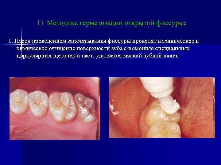 1) Методика герметизации открытой фиссуры: 1. Перед проведением запечатывания фиссуры проводят механическое и химическое