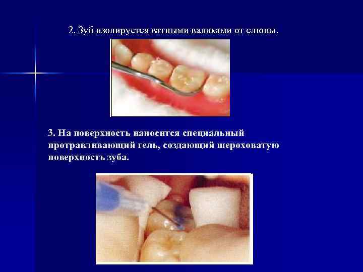 2. Зуб изолируется ватными валиками от слюны. 3. На поверхность наносится специальный протравливающий гель,