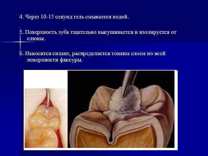 4. Через 10 -15 секунд гель смывается водой. 5. Поверхность зуба тщательно высушивается и
