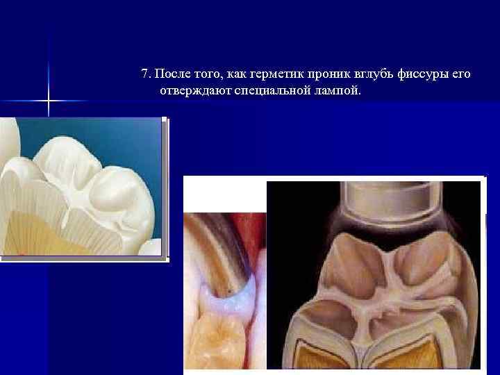 7. После того, как герметик проник вглубь фиссуры его отверждают специальной лампой. 