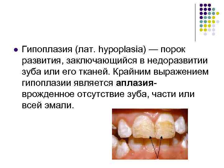 l Гипоплазия (лат. hypoplasia) — порок развития, заключающийся в недоразвитии зуба или его тканей.