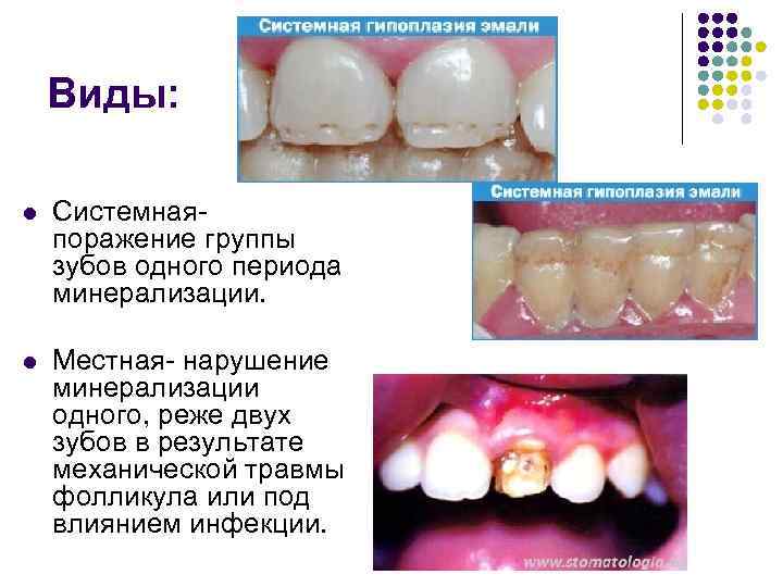 Виды: l Системнаяпоражение группы зубов одного периода минерализации. l Местная- нарушение минерализации одного, реже