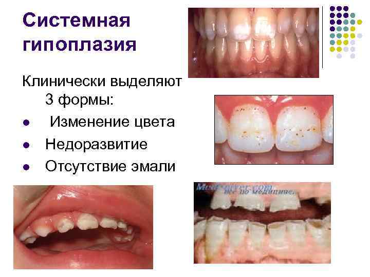 Системная гипоплазия Клинически выделяют 3 формы: l Изменение цвета l Недоразвитие l Отсутствие эмали